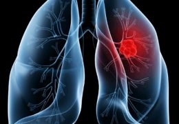 Saiba o que é adenocarcinoma pulmonar, câncer que atinge o Papa Leão