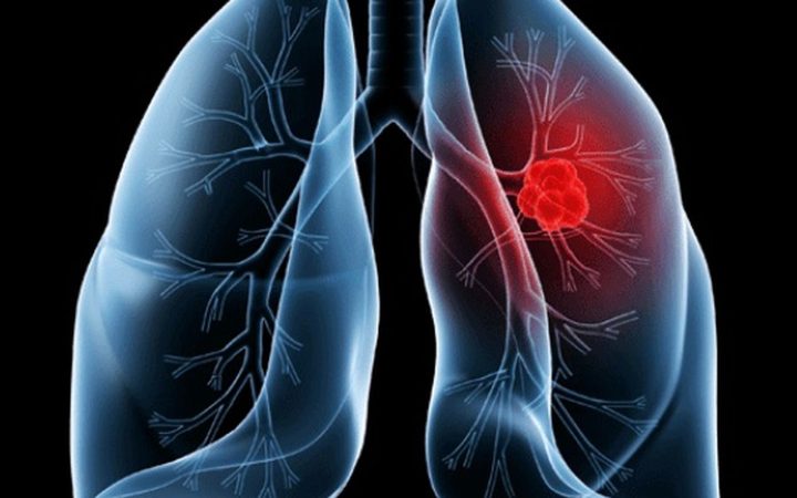 Saiba o que é adenocarcinoma pulmonar, câncer que atinge o Papa Leão